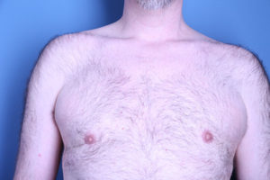 after gynecomastia surgery front view of male patient 3594