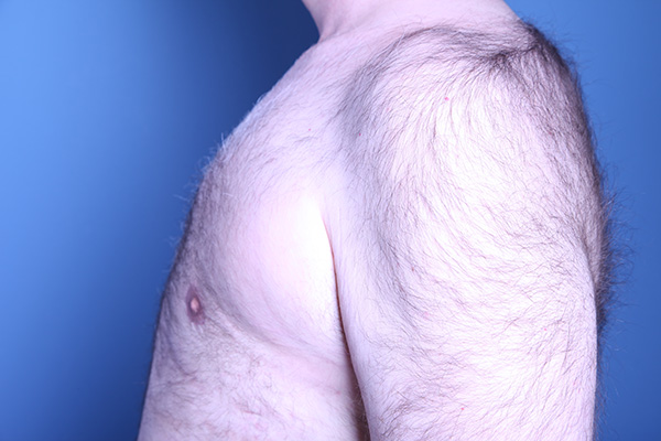 after gynecomastia surgery left side view of male patient 3594
