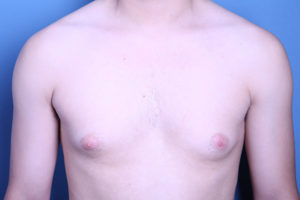 before gynecomastia surgery front view of male patient 3599
