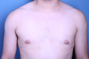 after gynecomastia surgery front view case 3599