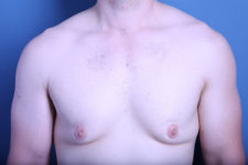 before gynecomastia surgery front view case 3602