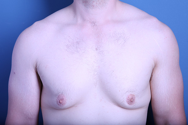 before gynecomastia surgery front view case 3602