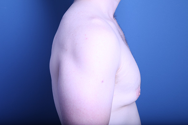 before gynecomastia surgery right side view case 3602