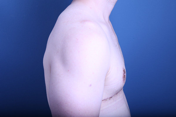 after gynecomastia surgery right side view case 3602