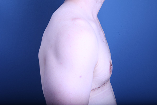 after gynecomastia surgery side view case 3602