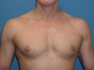 before gynecomastia surgery front view case 3608