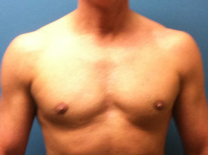 after gynecomastia surgery front view case 3608