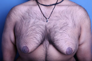 before gynecomastia surgery front view case 3611