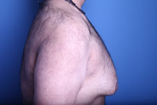 before gynecomastia surgery right side view case 3611