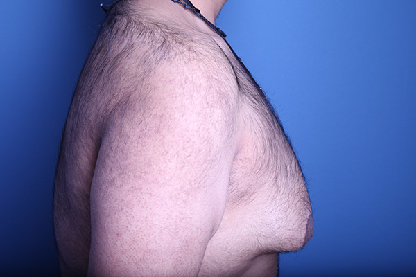 before gynecomastia surgery right side view case 3611