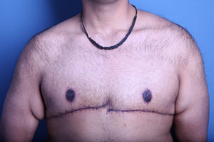 after gynecomastia surgery front view case 3611