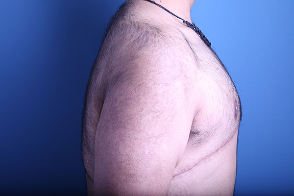 after gynecomastia surgery right side view case 3611