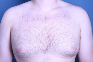 before gynecomastia surgery front view male patient case 3616