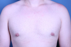 after gynecomastia surgery front view male patient case 3616