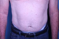 before Liposuction male patient front view case 3358