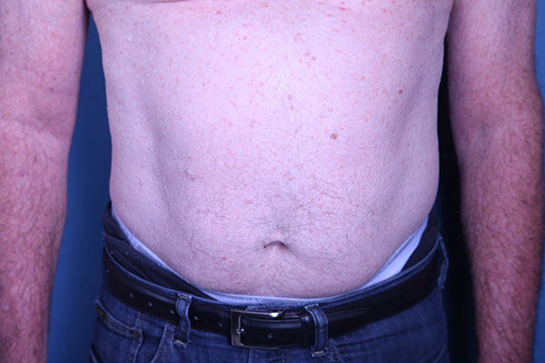 before Liposuction male patient front view case 3358
