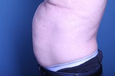before Liposuction male patient side view case 3358