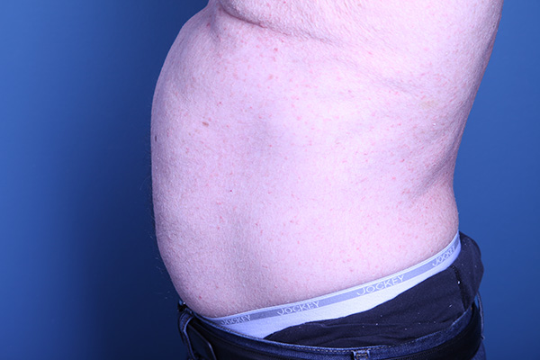before Liposuction male patient side view case 3358