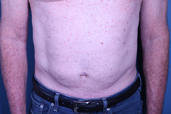 after Liposuction male patient front view case 3358