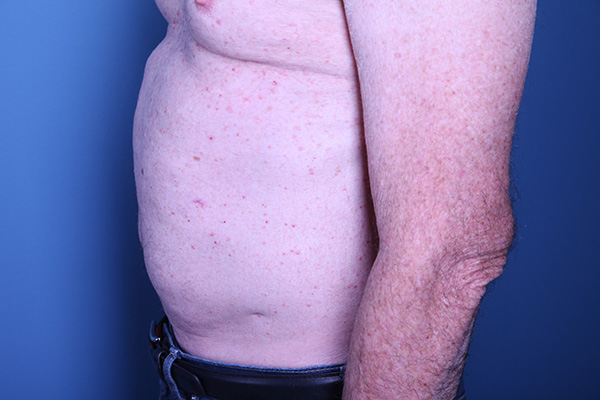 after Liposuction male patient side view case 3358