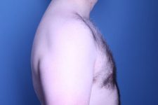 after gynecomastia surgery right side view male patient case 4408