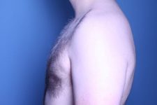 after gynecomastia surgery left side view male patient case 4408