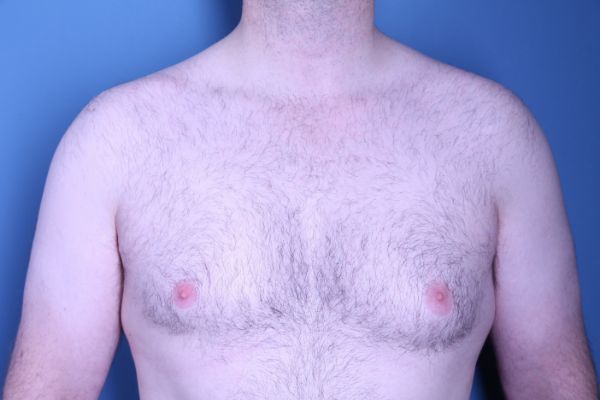 before gynecomastia surgery front view male patient case 4408