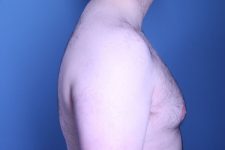 before gynecomastia surgery right side view male patient case 4408