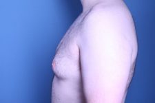 before gynecomastia surgery left view male patient case 4408