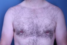 after gynecomastia surgery front view male patient case 4408