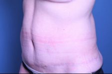 after tummy tuck left angle view female patient case 4461