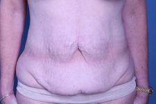 before tummy tuck front view female patient case 4461
