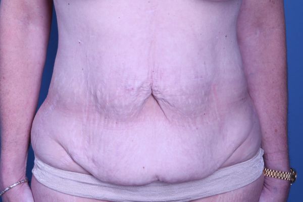 before tummy tuck front view female patient case 4461
