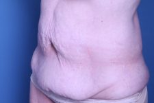 before tummy tuck left angle view female patient case 4461
