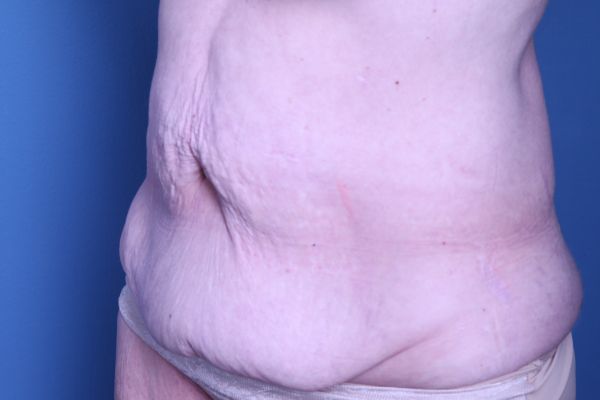 before tummy tuck left angle view female patient case 4461