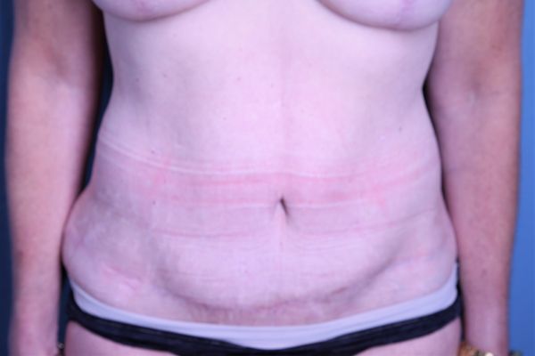 after tummy tuck front view female patient case 4461
