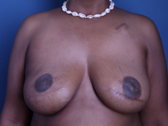 after breast reconstruction front view female patient case 4468