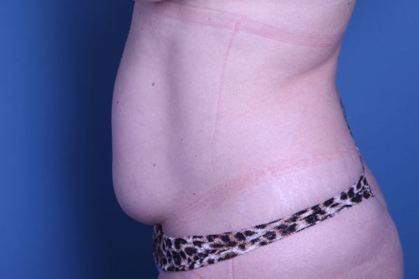 before abdominoplasty left side view female patient case 5227