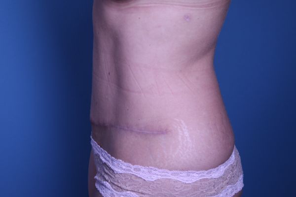 after abdominoplasty left side view female patient case 5227